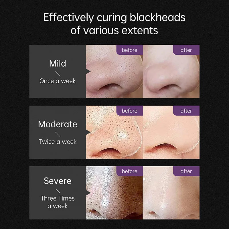 Cleanuest™ - Blackhead Remover Mask